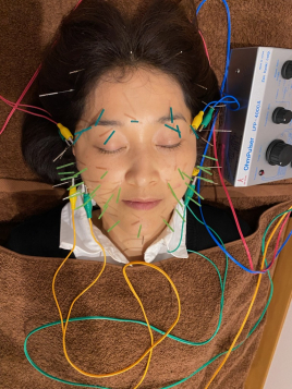 メニュー:侑秀オリジナル美容鍼コース イメージ