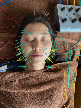 メニュー:プレミアム美容鍼コース イメージ